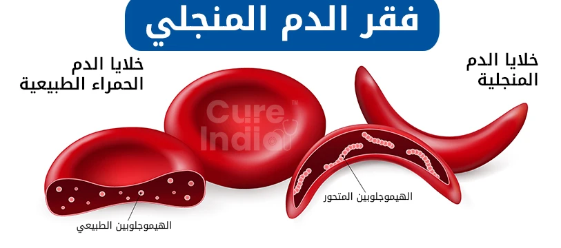 ما هو فقر الدم المنجلي